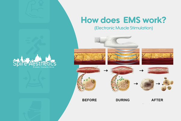 EMS treatment for post pregnancy weight loss treatment Beaconsfield