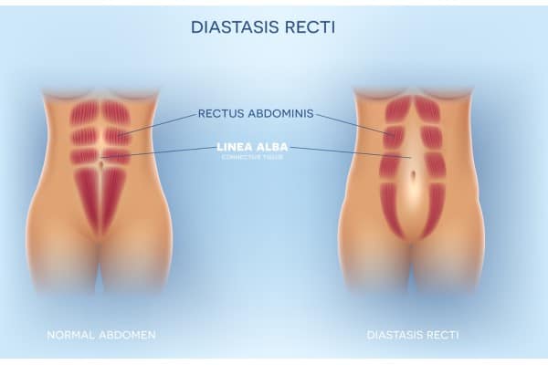 What Non-Surgical Options Are Available for Diastasis Recti Beaconsfield?