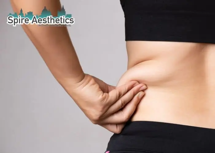 Image of woman pinching fat on their hips Beaconsfield. Fat Freezing treatment