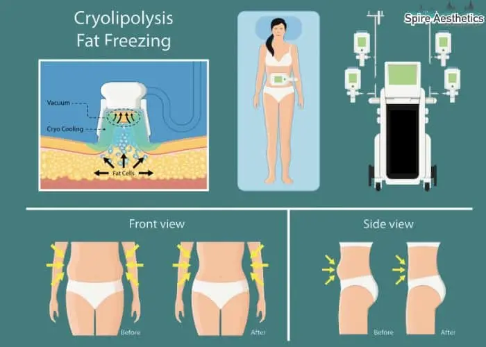 Fat freezing treatment Beaconsfield benefits for competitions to remove stubborn fat deposits.