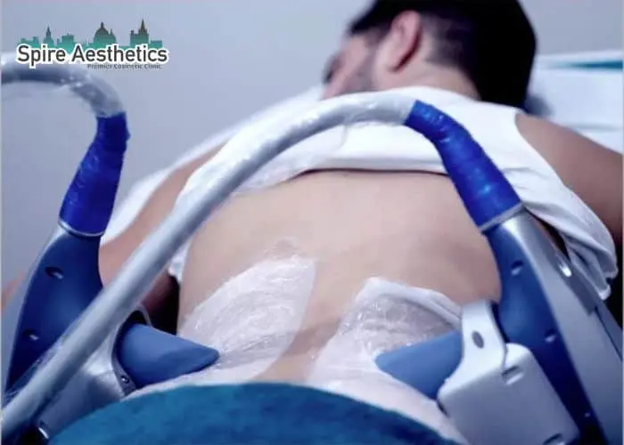 Man having fat freezing treatment done on love handles before a competitions Beaconsfield to create a sculpted look.