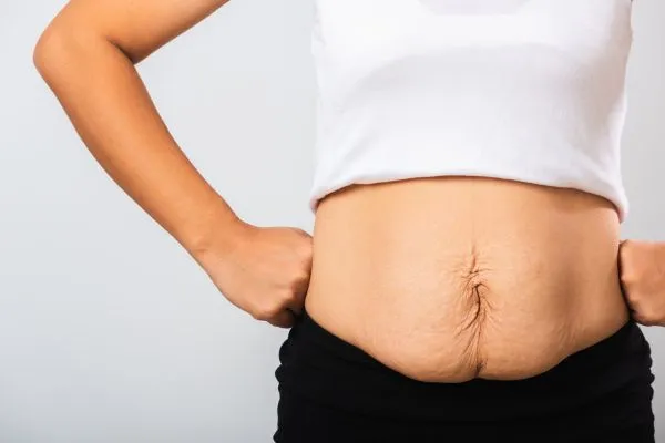 Image of a woman's stomach after weight loss with sagging skin following a gastric band Beaconsfield