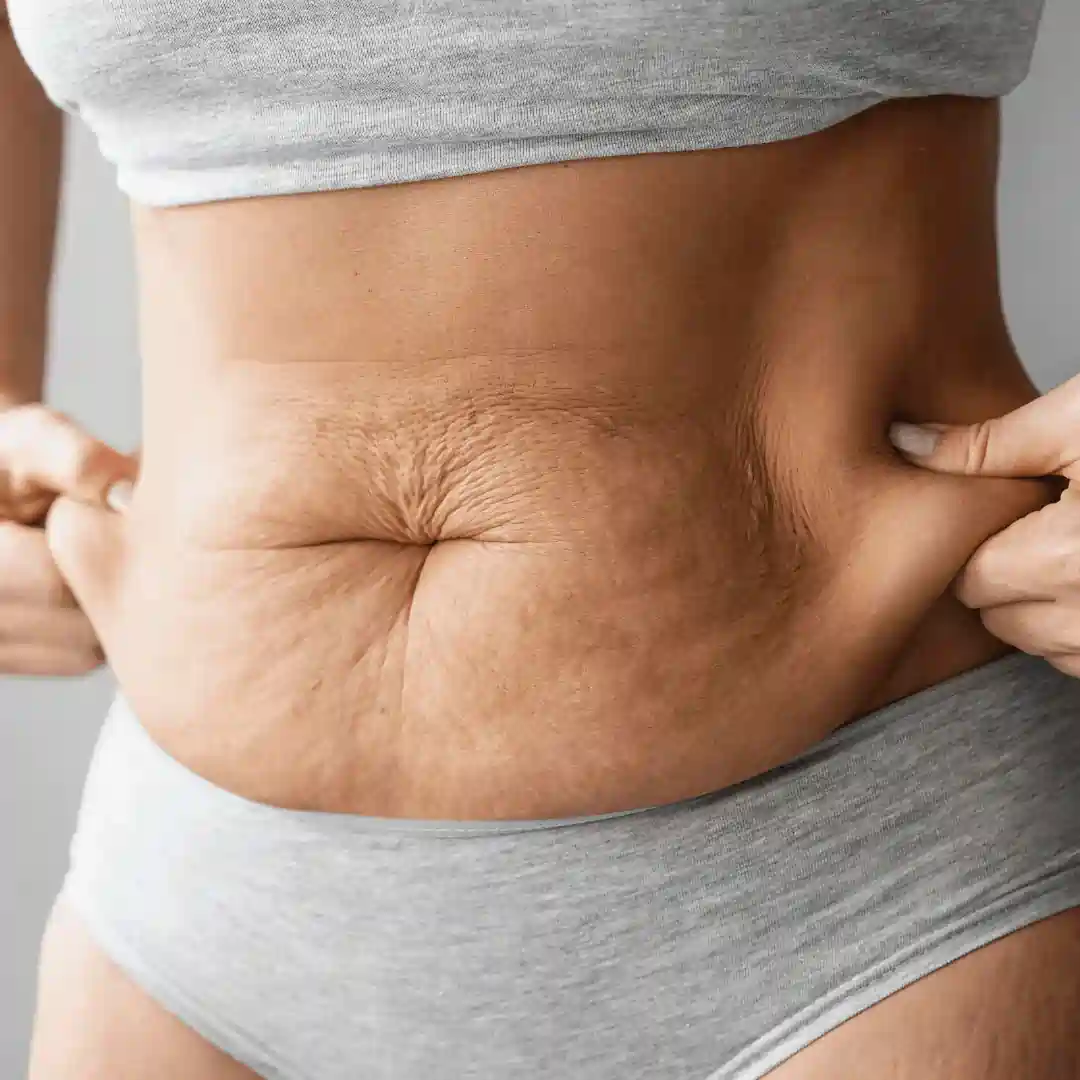 Is It Normal to Have Loose Skin After Pregnancy Beaconsfield?