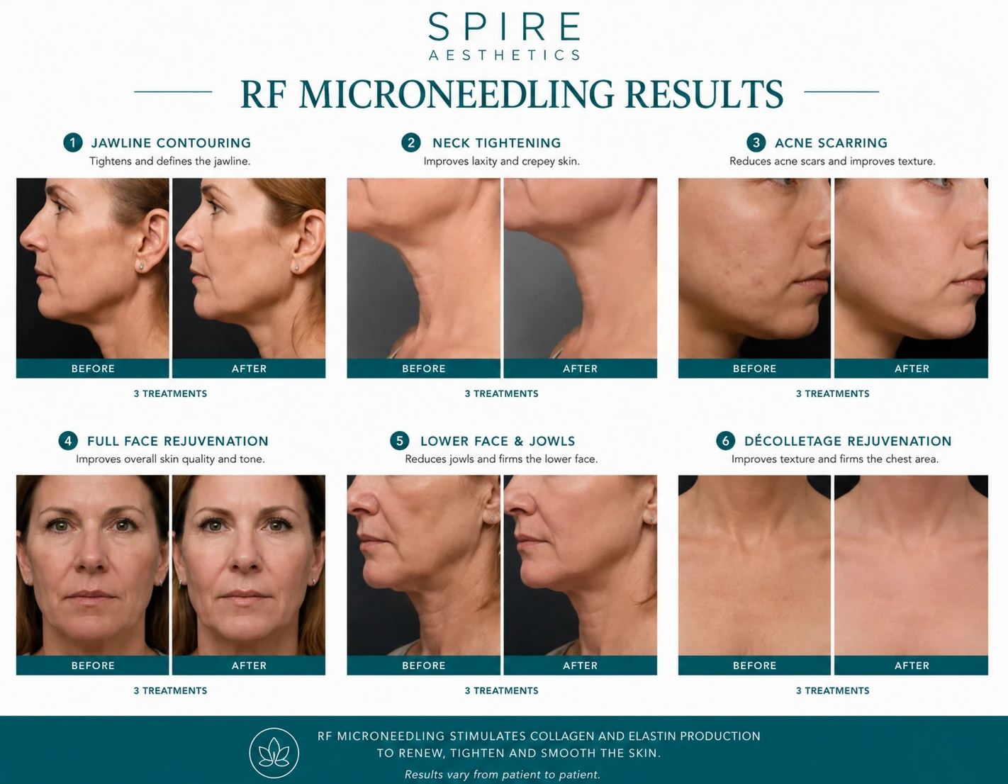 RF Microneedling Skin tightening Beaconsfield results