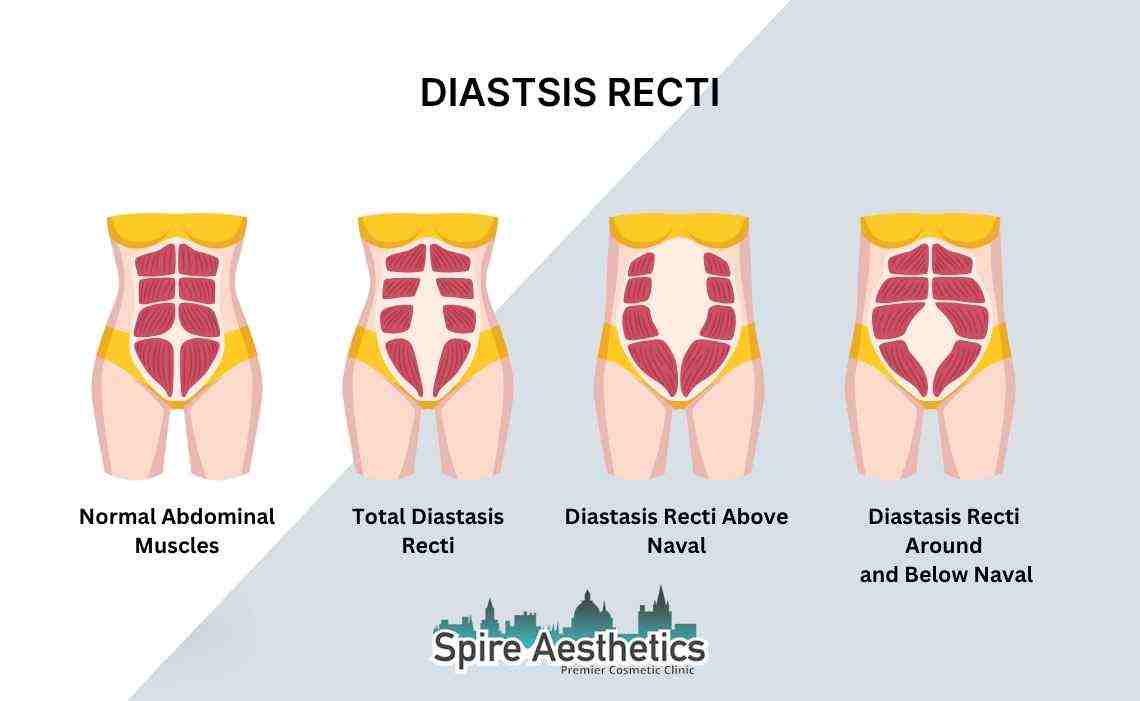 Is Non-Surgical Diastasis Recti Treatment Right for You? Common Concerns Answered Beaconsfield